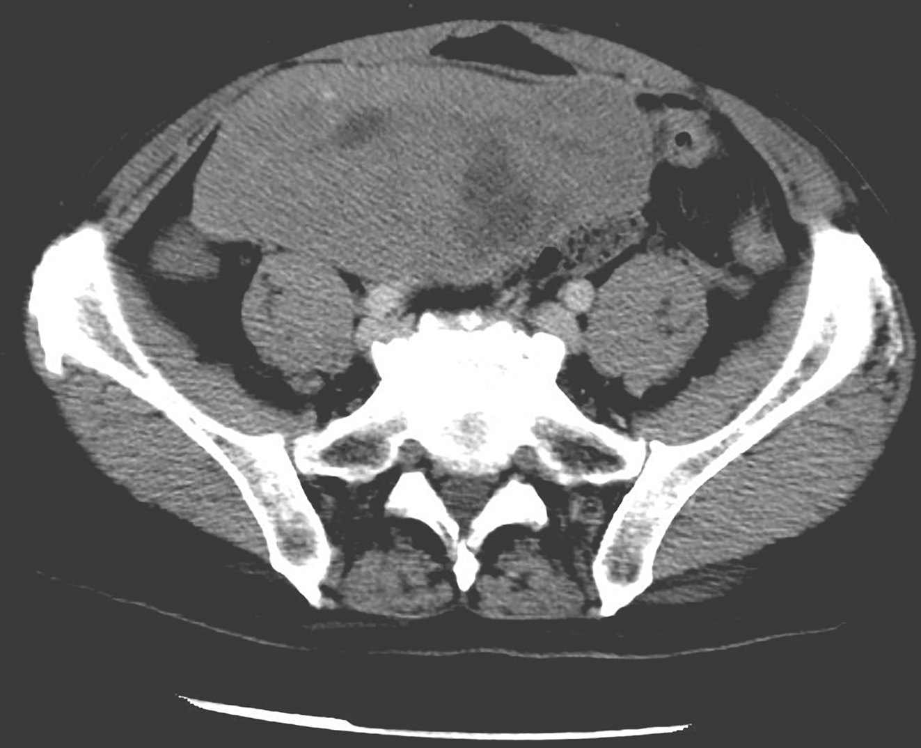 图2 服用伊马替尼1个月后复查腹盆腔增强CT